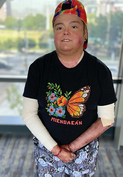 Patient with RDEB Skin Disease
