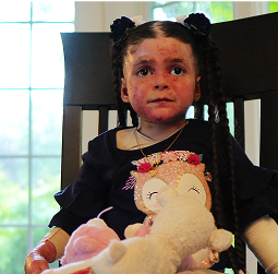 Patient with RDEB Skin Disease